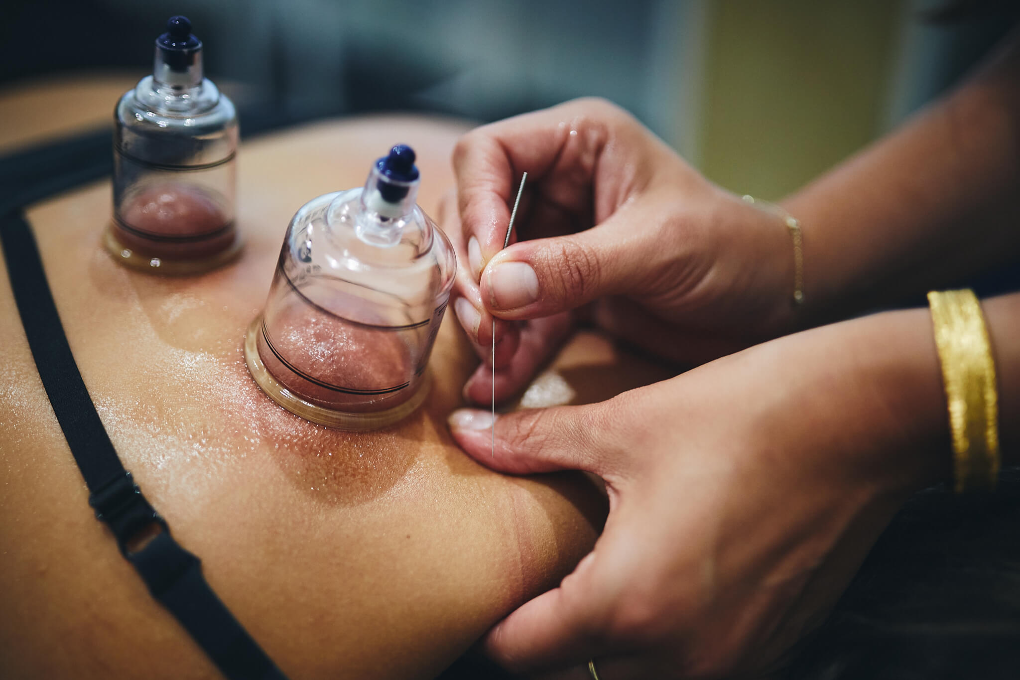 cupping therapy sydney