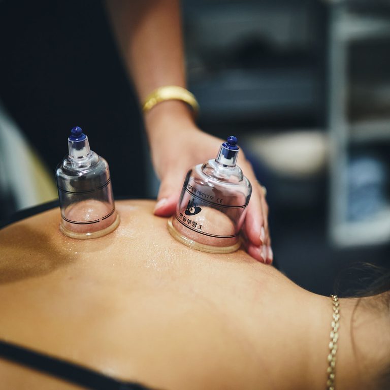 cupping service sydney