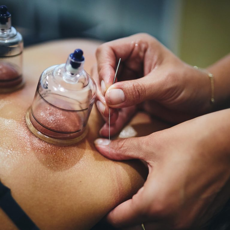 cupping therapy sydney